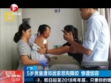 广东：5岁男童遭邻居家恶狗撕咬  惨遭毁容